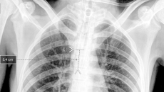 A chest x-ray showing Qure.ai's technology for breathing tube placement