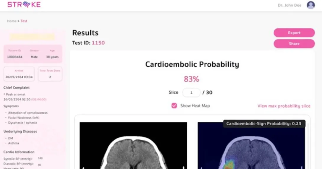 An interface of the AICute web application for the assessment of stroke risk developed by Chulalongkorn University researchers