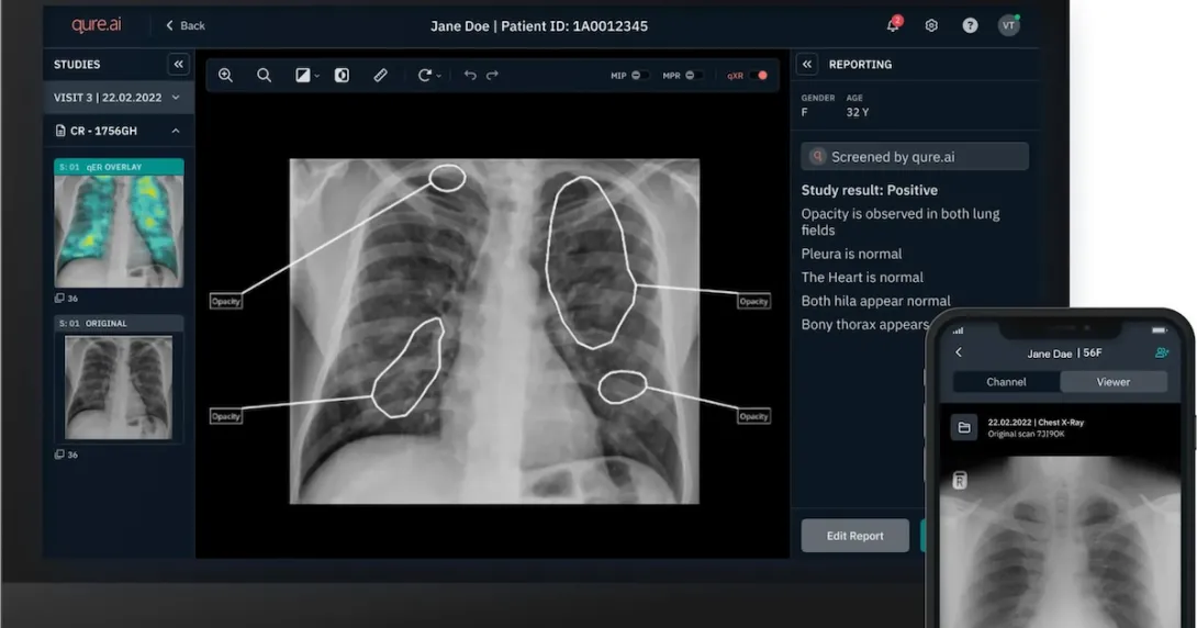 Mobile and desktop versions of Qure.ai's chest X-ray analysis solution