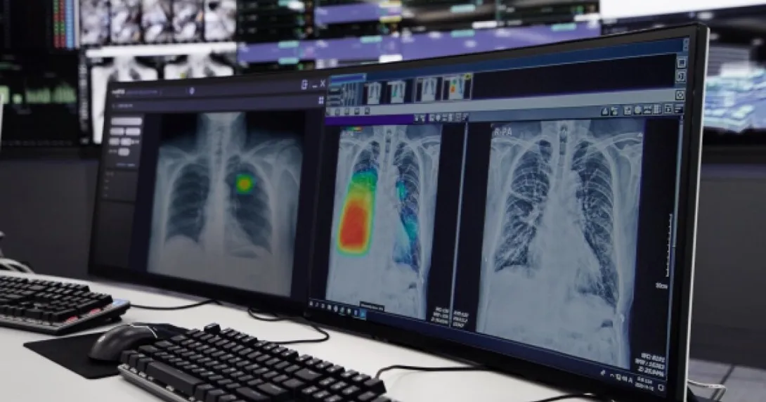 Computer screens showing a chest x-ray analysis report