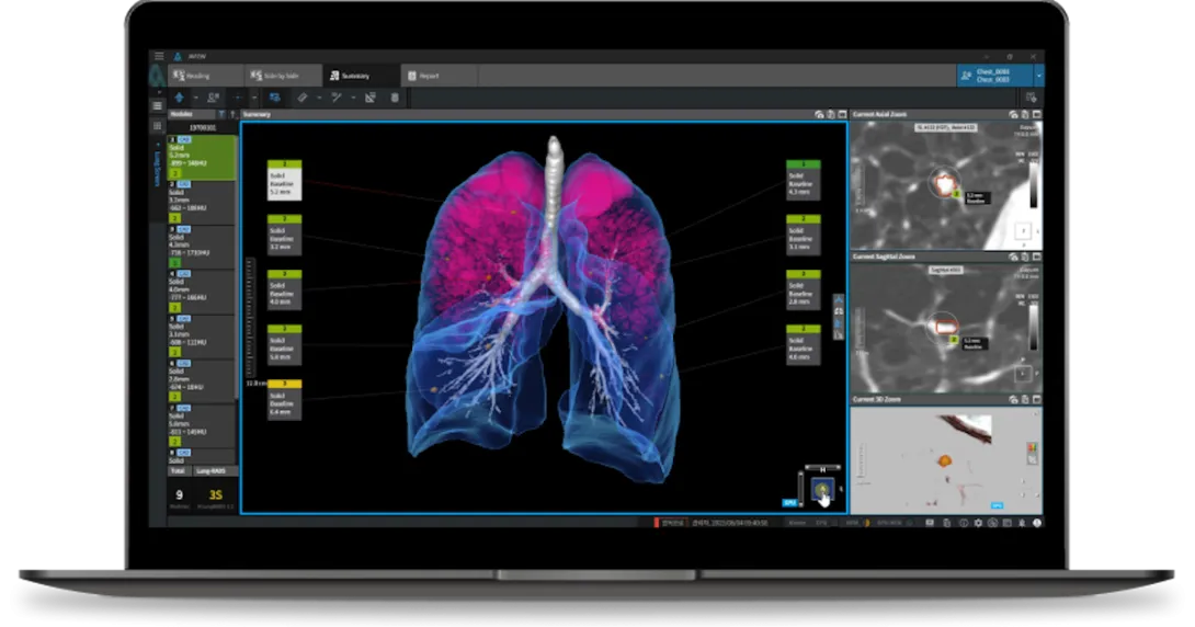 Interface of Coreline Soft's lung cancer imaging AI software